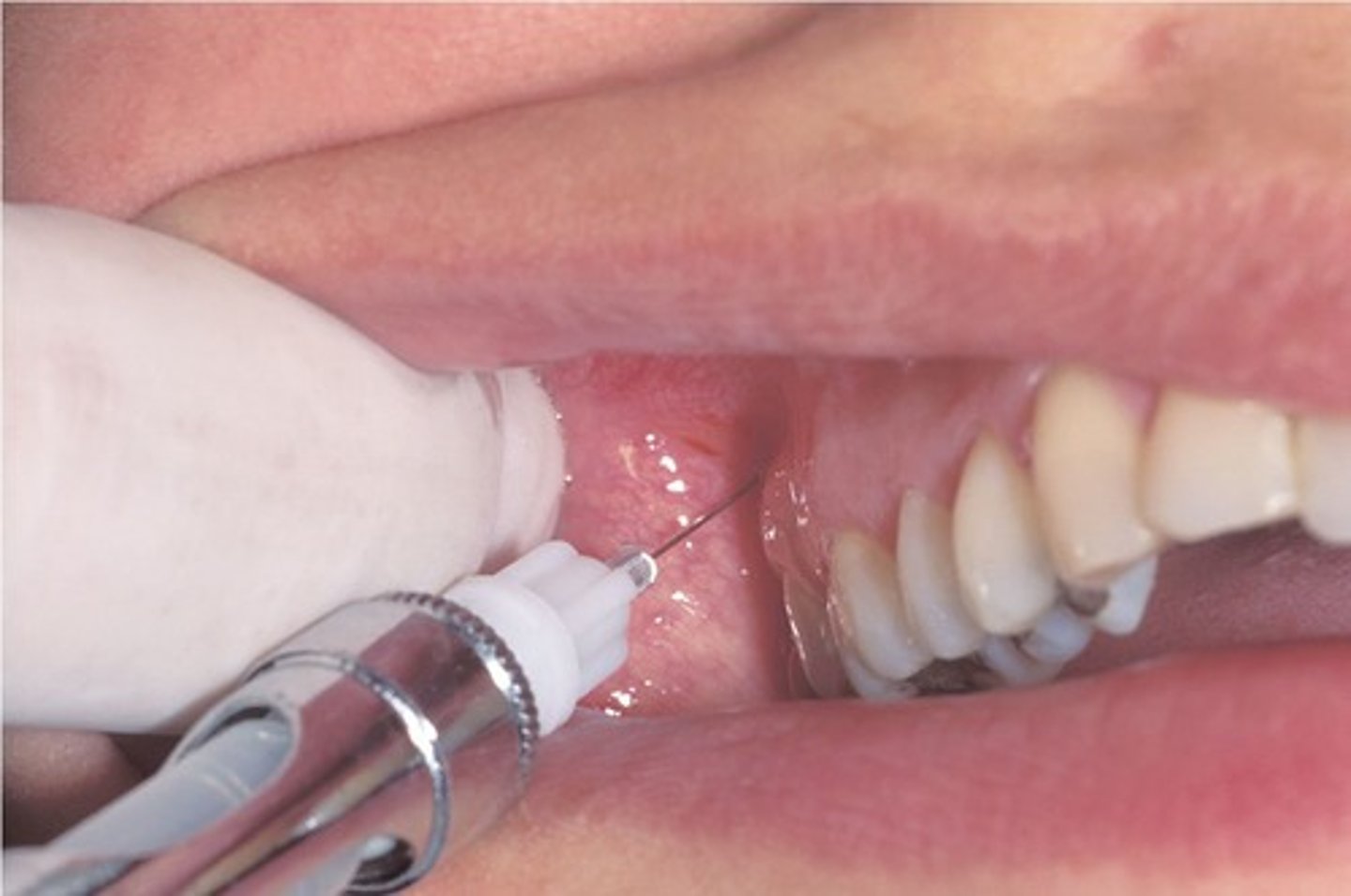 <p>muccobuccal fold at the apex of MX 2nd Molar</p>