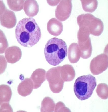 <p>(Pelger Huet/Pseudo Pelger Huet) anomaly is NOT clinically significant with <strong>normally functioning</strong> bi-lobed neutrophils. </p>