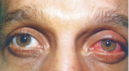 <p>Circumcorneal Redness. Caused by infections, trauma. Get medical attention. </p>