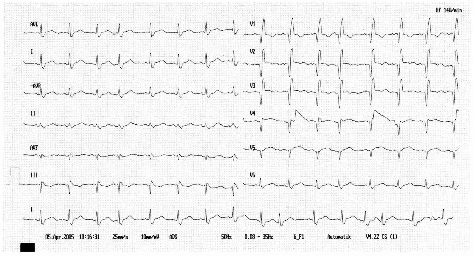<p>D. Supraventricular extrasystole</p>