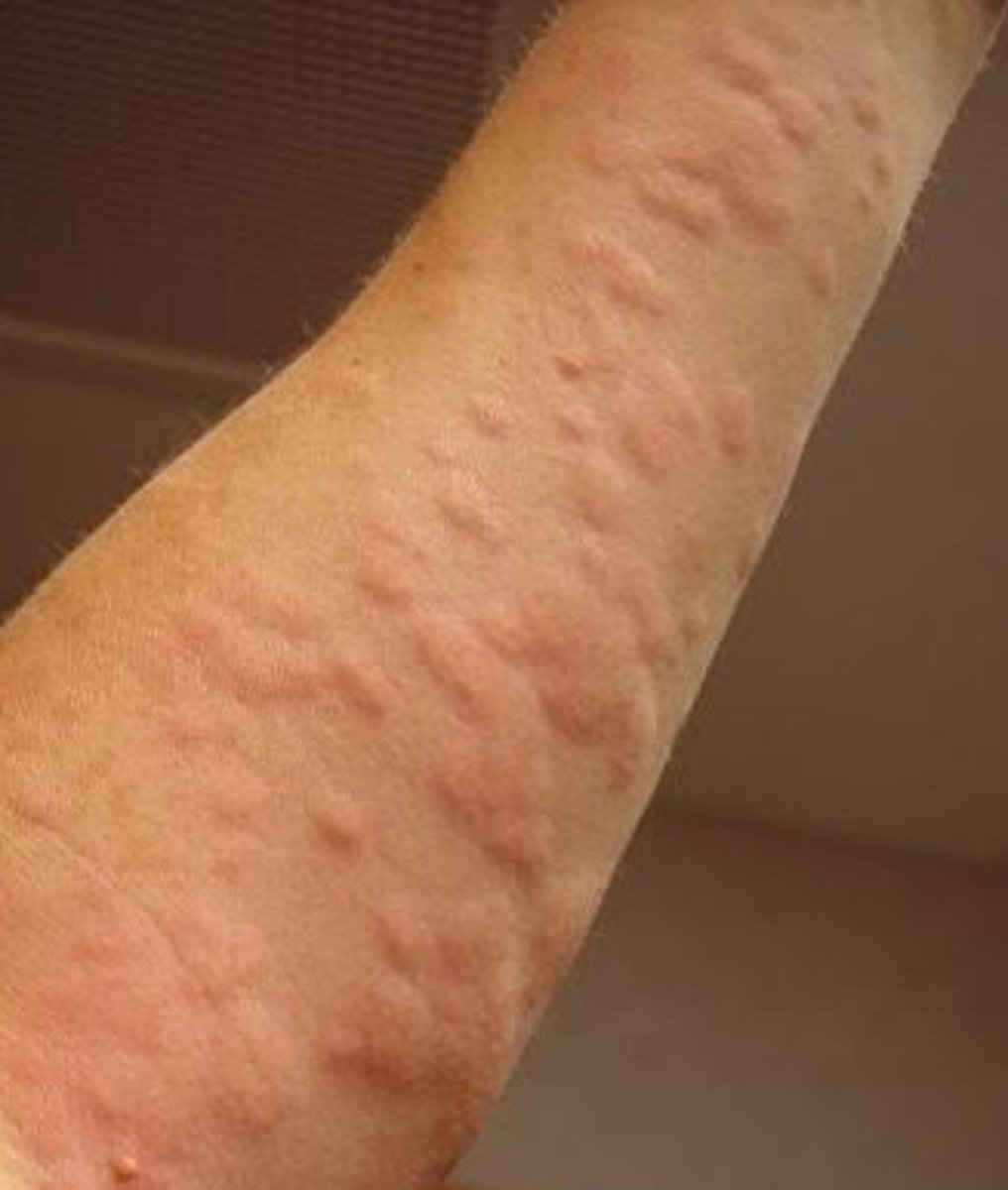 <p><b>Primary</b> <br><br>An irregular, often reddish or deeper brown superficial area of localized skin edema <br><br>example: uticaria</p>