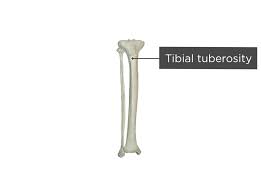 <p>Tibial Tuberosity</p>