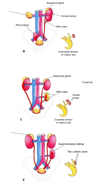 <p><span><span>Duplications of the Urinary Tract:</span></span></p><ul><li><p><span><span>result from division of one ureteric bud</span></span></p><ul><li><p><span><span>incomplete division --> divided kidney with a bifid ureter (B)</span></span></p></li><li><p><span><span>complete division --> double kidney with bifid ureter (C)</span></span></p></li></ul></li><li><p><span><span>formation of 2 ureteric buds</span></span></p><ul><li><p><span><span>supernumerary kidney with own ureter (F)</span></span></p></li></ul></li></ul><p></p>