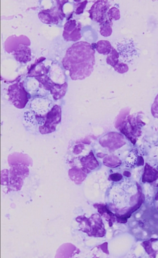 * Outside of circulation
* Seen in NUCLEUS
* Nuclear swelling
* Loss of segmentation
* Loss of coarse nuclear chromatin pattern
* In peripheral tissues, starting to fall apart, doing their job
* Found as neutrophils break down/die
* Can become prominent w bacterial infections