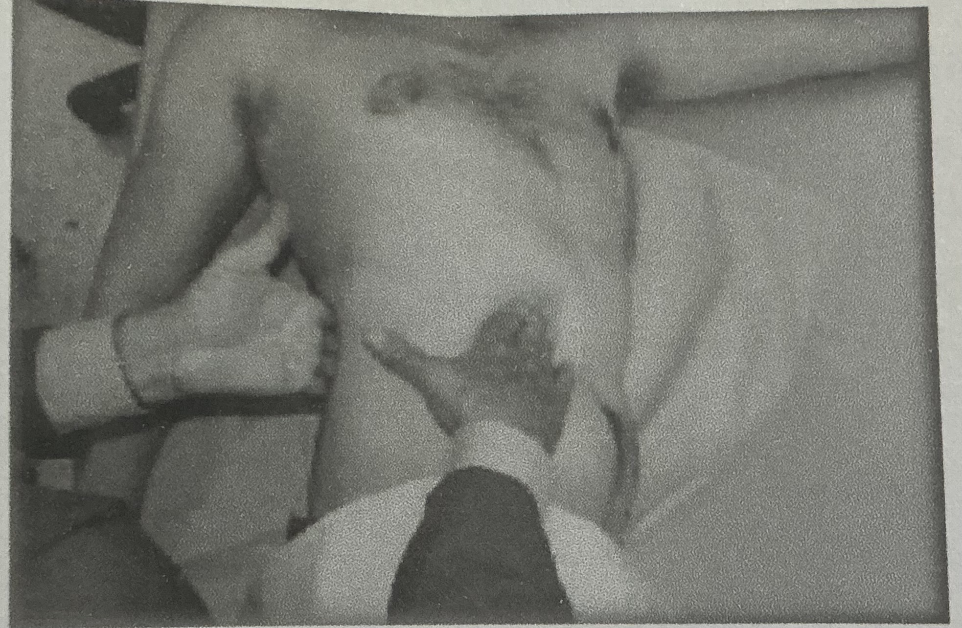 <p>El paciente se acuesta en decúbito lateral sobre el lado opuesto al riñón a examinar con caderas y rodillas en semiflexión.</p><p>El médico se coloca en el lado abdominal, mirando a la cabeza del paciente, o en el lado dorsal y sentado en la cama.</p><p>Dispone sus manos, de <strong>forma que la de sostén </strong>esté de plano en la región lumbar, fuera de la masa de los músculos vertebrales.</p><p>La otra<strong> mano presiona</strong> con la punta de los tres dedos debajo de la confluencia del noveno y décimo cartílagos costales.</p><p>Con los dedos flexionados, se explora el riñón, solicitando al paciente que respire profundo, haciendo presión con la mano en la región lumbar.</p>