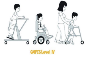 <ul><li><p>level IV</p><ul><li><p>patient self mobility will be severely limited</p></li><li><p>children are transported or use power mobility outdoors and in the community</p></li></ul></li></ul><p></p>