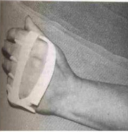<p><strong>Static dorsal hand orthosis with an MCP block </strong></p><p><strong>Function:</strong></p><ul><li><p>It is a type of hand orthosis that immobilizes the hand while specifically blocking or restricting the movement of the MCP.</p></li><li><p>The MCP block in the orthosis stabilizes and prevents excessive ulnar deviation of the fingers by keeping the MCP joints in a neutral or aligned position.</p></li></ul><p></p>