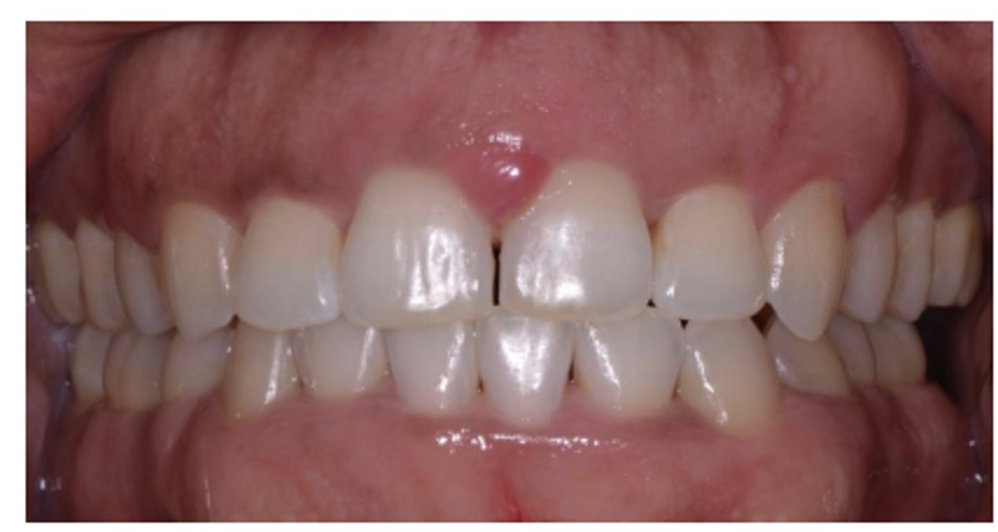<p>Square-shaped teeth</p><p>Flat gingival margin</p><p>Dense and fibrotic tissue</p>