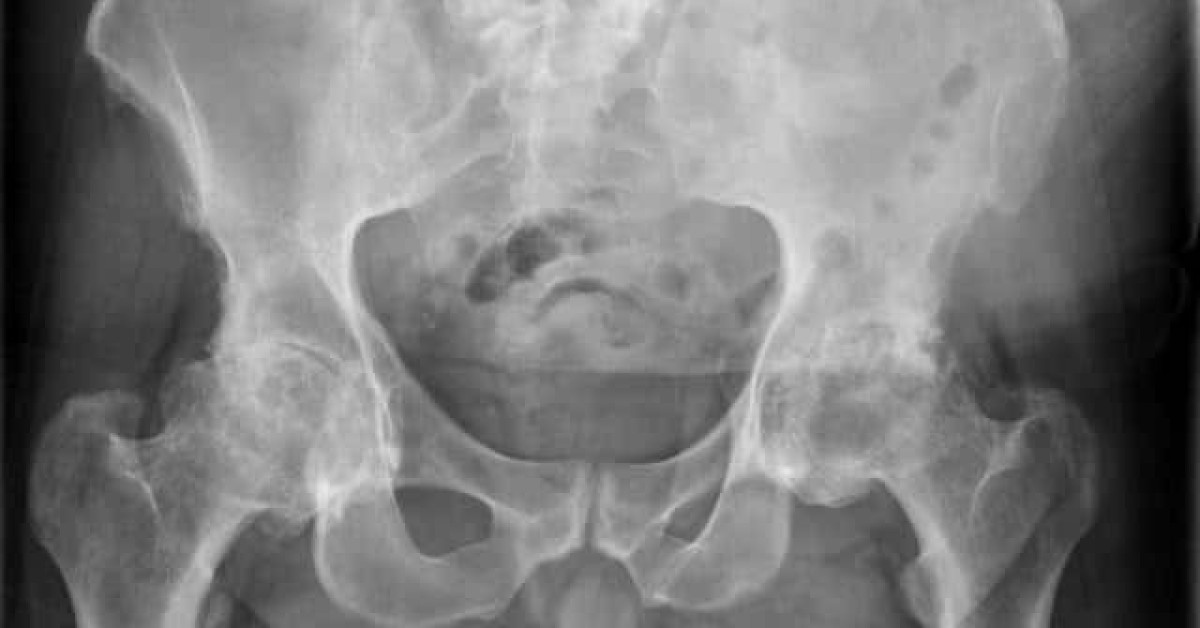 <p>what rotational translation could be suggested with a mismatched obturator foramen?</p>