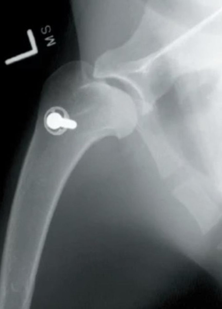 <p>First we try to treat biceps tenosynovitis with medical management, what does this consist of?</p><p>If this doesn't work, what do we do next?</p>