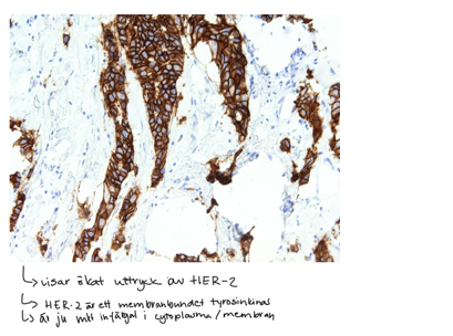 <p>Genetik (germline, förvärvad), strålning, kemikalier, virus, näringsobalans, inflammation, hormoner</p>