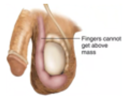 <p>Large hernias‬ can extend into the scrotum‬ causing pain and swelling‬</p>