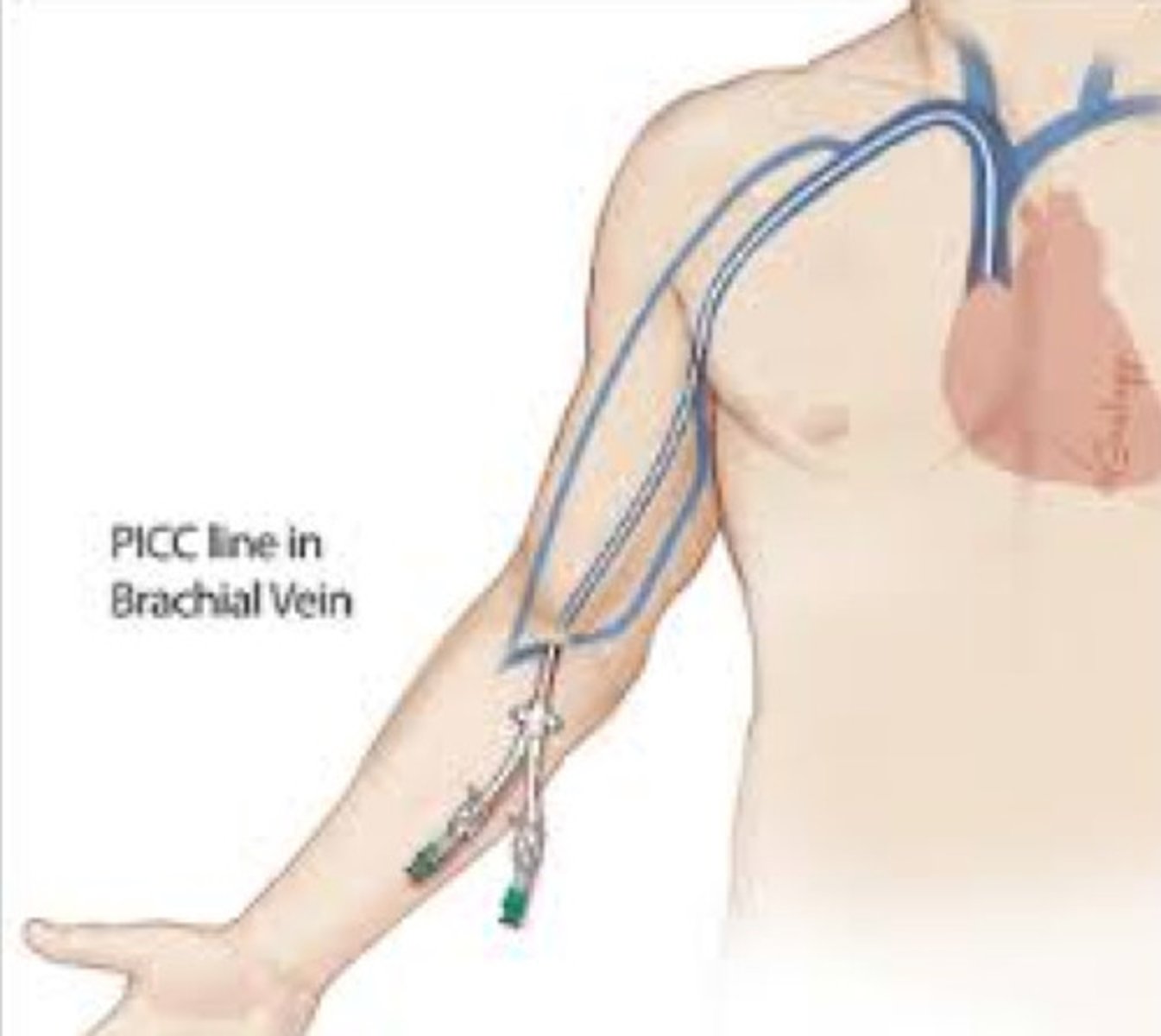 <p>typically placed in upper arm</p>