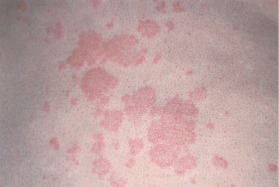 <p>something you can feel (solid, elevated, circumscribed) caused by the superficial thickening of the epidermis.</p><p>e.g., moles, warts, psoriasis</p>