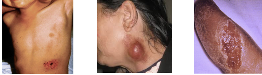 <ul><li><p>Etiological agent of tularemia, a disease also known as glandular</p><p>fever, tick fever, and occasionally as deer fly fever, rabbit fever (zoonoses) and market men’s fever.</p></li><li><p>Present in a wide variety of wild animals, birds, and some fish or amphibians</p></li><li><p><strong>Potential Bioterror Agent (Category A infectious agent).</strong></p><ul><li><p>Extremely virulent, disease occurs at low infective dose ( 10 colony forming unit)</p></li><li><p>Nationally reportable disease- presumptive ID requires notification of local health department, state health department, as well as national.</p></li></ul></li></ul><p></p>