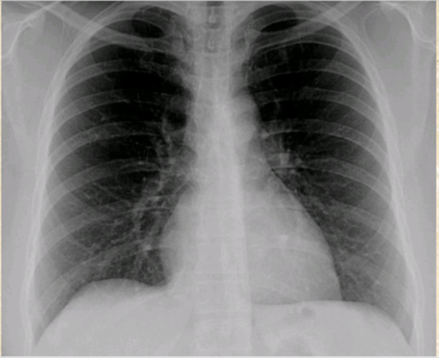 <p>What is wrong with this CXR?</p>