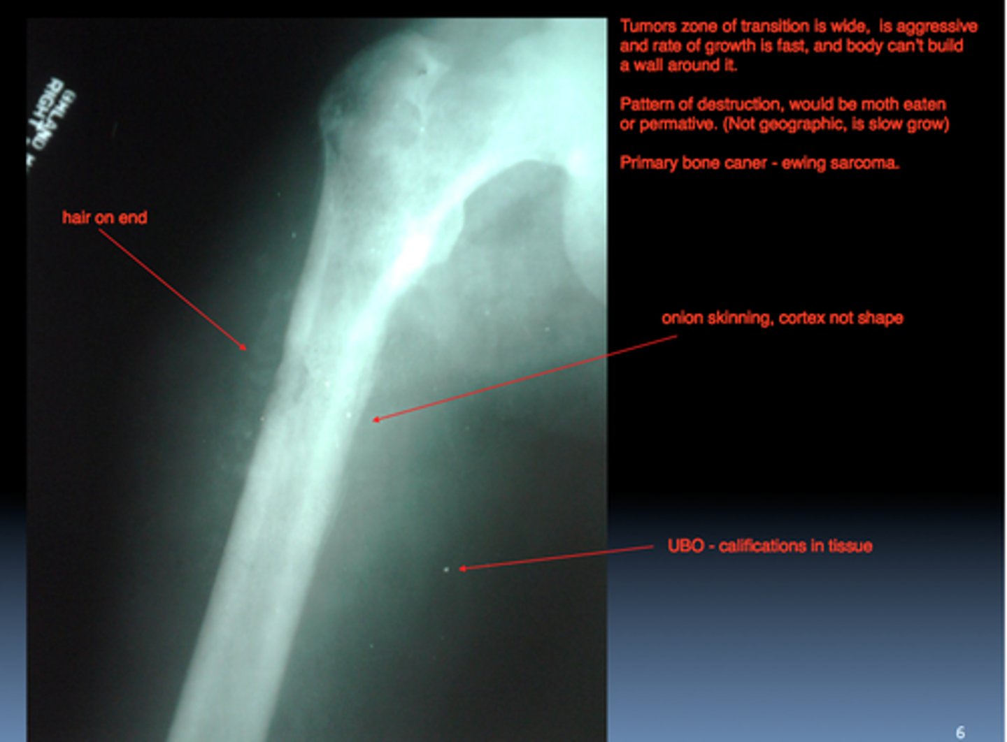 <p>X ray shows an osteolytic lesion with a periosteal reaction that produces layers of reactive bone, giving the classic onion skin appearance</p>