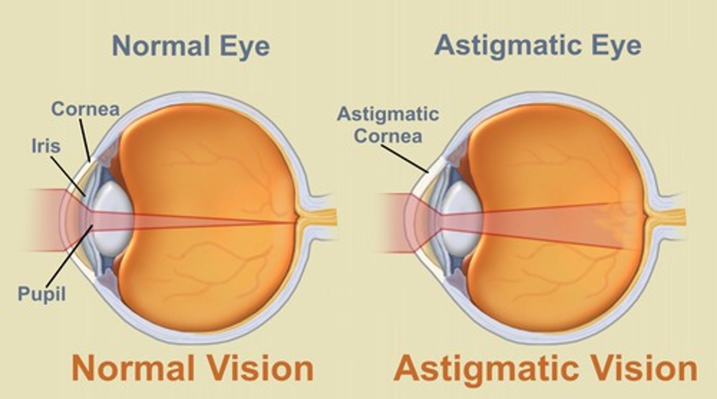 <p>defective curvature of the cornea or lens of the eye - causes distortion</p>