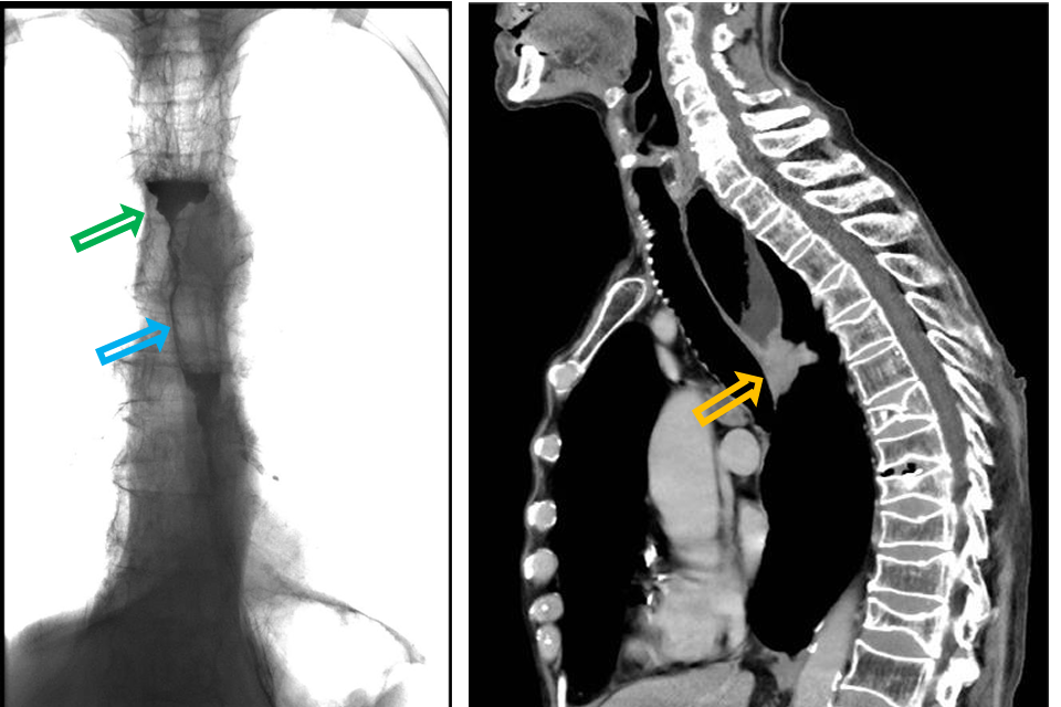 <p>Patient history: dysphagia and weight loss in a middle-aged male patient with alcoholism </p><p>Modality: left – Barium swallow test, fluoroscopy, coronal view; right – contrast enhanced CT (iv. contrast agent), soft tissue window, sagittal view </p><p>Region: chest </p><p>Radiologic sign: contrast enhancing mass (yellow arrow) causing dilatation of the upper third of the esophagus; cranially to the mass the oral contrast agent is accumulated (green arrow), only a small amount of contrast agent passes through the stenosis (blue arrow). </p><p>Diagnosis: squamous cell carcinoma of the esophagus</p>