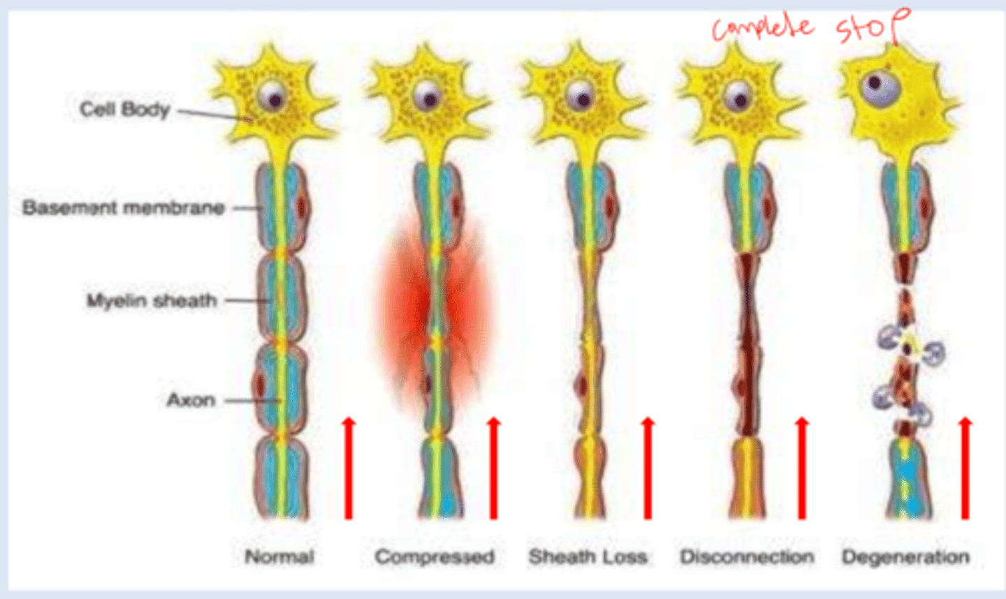 <p>-no signals sent or received by brain</p><p>-signals unable to make the "jump" between the severed nerve</p>