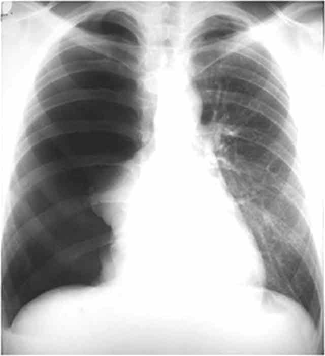 <p>What could the collapsed portion of lung tissue adjacent to the right side of the mediastinum also be known as?</p>