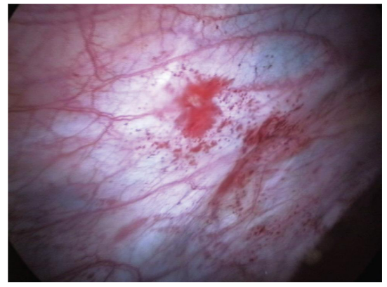 <ul><li><p><span style="background-color: transparent;"><u><span>Endometriosis</span></u><span> is the growth of endometrium in places other than the uterus</span></span></p></li><li><p><span style="background-color: transparent;"><span>The endometrium goes through the </span><u><span>menstrual cycle </span></u><span>no matter where it is located.</span></span></p></li><li><p><span style="background-color: transparent;"><span>Endometriosis can lead to infertility and painful periods (</span><u><span>dysmenorrhea</span></u><span>).</span></span></p></li></ul><p></p>