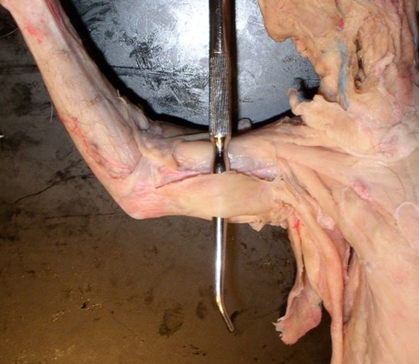 <p>Origin: latissimus dorsi</p><p>Insertion: olecranon process</p><p>Action: extends forearm</p>