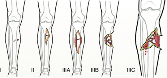 <p>What classification system is for open fractures?</p>