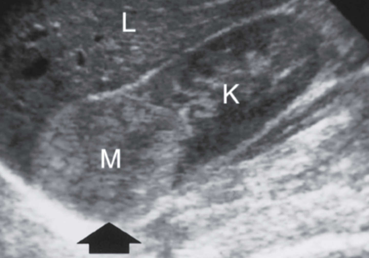 <p>a. Hypernephroma (RCC)</p>