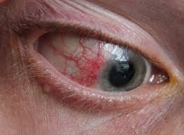 <p>inflammation of the sclera</p>