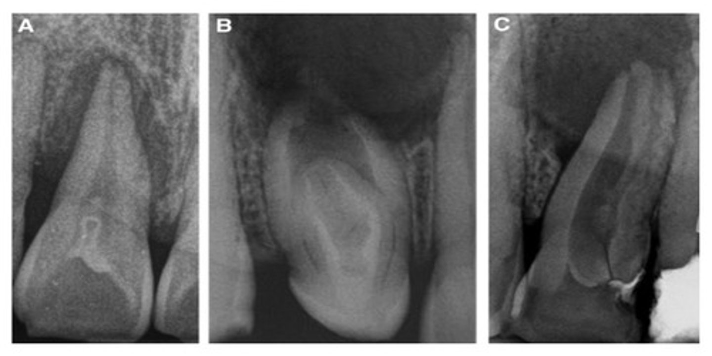 <p>Occurs when the enamel organ invaginates into the crown of a tooth before mineralization. Radiographically, it appears as a toothlike structure within a tooth. Vulnerable to caries, pulpal infection, and necrosis.</p>