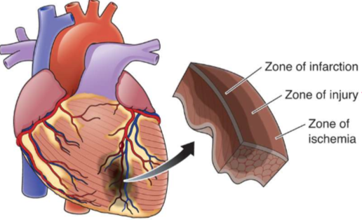 <p>What is happening in zone of infarction?</p>