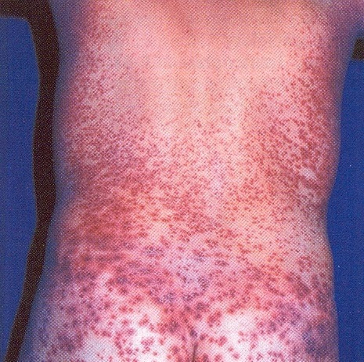 <p>Caused by Dengue Virus, spread by infected mosquito, treatments include pain-relievers, and fluids, no vaccine.</p>