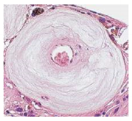 <p>A systemic vascular disease in small arteries and arterioles. Associated with stress caused by HTN that narrows the lumen of BV by making the BV thick and stiff. <strong>No emboli arise from arteriosclerosis.</strong></p>