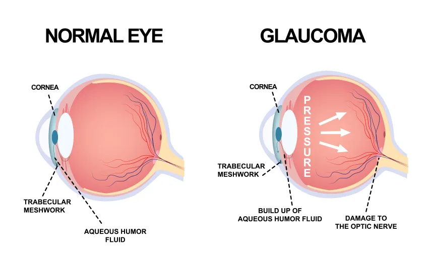 <p>A build up of pressure in the eye damages the optic nerve and the blood vessels that carry blood to the retina. This causes a blockage in the drainage channel that drains fluid from the aqueous humour.</p>