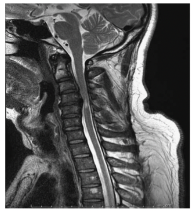 <p>Pathological reflexes of the Cervical spine → GET AN MRI </p>