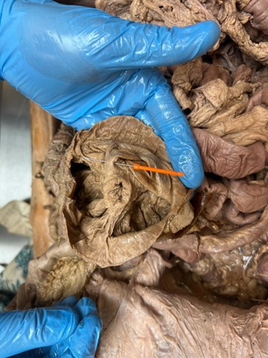 <p>posterior frenulum of ileal orifice</p>