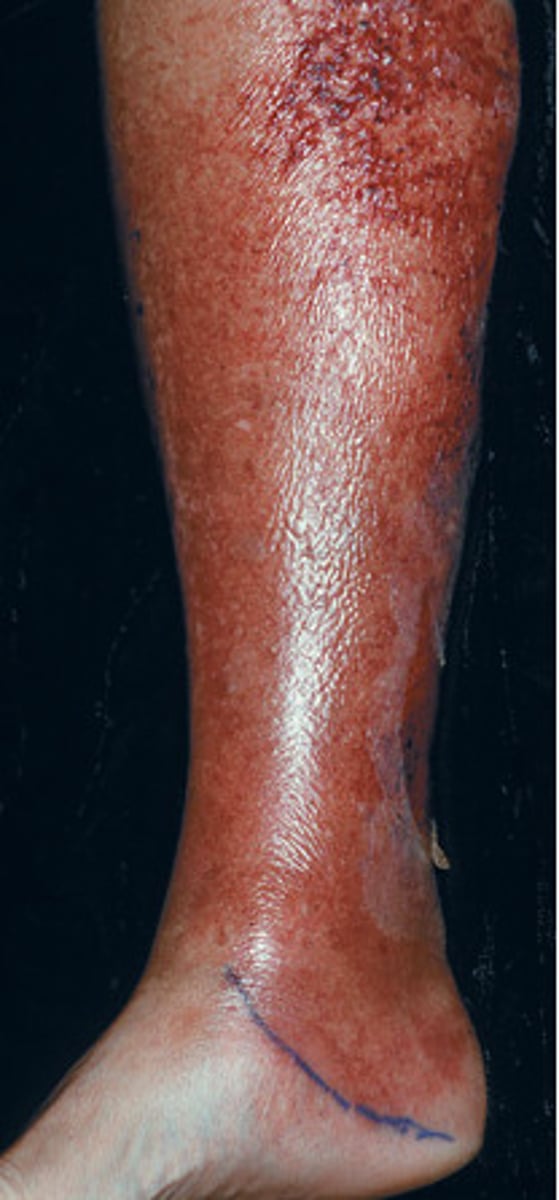 <p>Erysipelas</p>