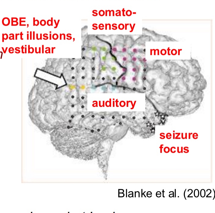 <ul><li><p>Make sure the part that is being cut, is not crucial to quality of life.</p></li><li><p>Dr opened skull while patient was awake, using local anesthesia, and place a mesh of electrodes (coloured dots).</p></li><li><p>Then stimulate each electrode separately to see what the response of the patient is</p></li><li><p>When stimulate electrodes coloured in</p><ul><li><p>blue → auditory illusions</p></li><li><p>Green → felt she was being touched, somatosensory illusions</p></li><li><p>Purple → movements from person, motor</p></li><li><p>Yellow → out of body experiences, body part illusions, vestibular ( angular gyrus was stimulated)</p><ul><li><p>Vestibular: sinking into the bed, falling</p></li><li><p>“I see myself lying in bed, from above, but I only see my legs and lower trunk”</p></li></ul></li></ul></li></ul><p></p>