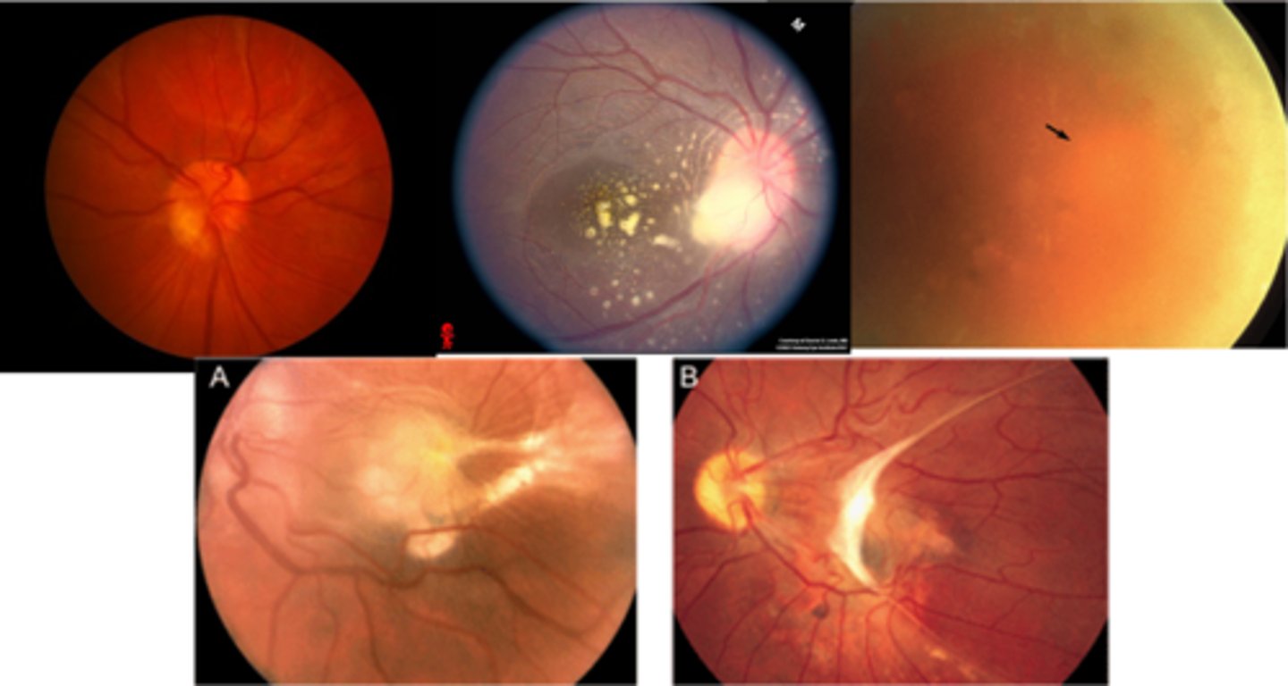 <p>depends on lesion location</p><p>if presenting vision poor, outcomes typically poor</p>