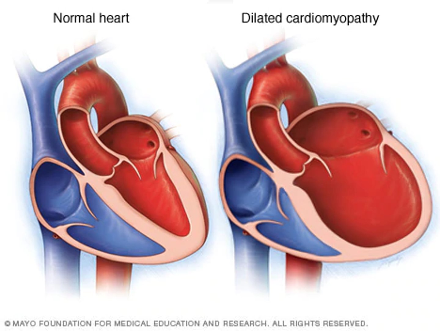 <p>-most common type</p><p>-heart chambers are enlarged and weakened causing poor systolic function and decreased cardiac output and blood stagnation</p><p>-when ventricles become enlarged, baggy, and weak. they are overstretched!</p><p>-typically starts in the left ventricle and then reaches the right ventricle</p>
