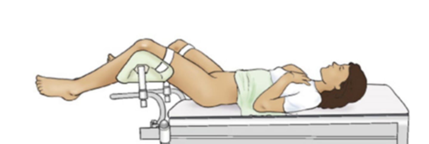 <p>where the patient is on their back with legs elevated and supported in stirrups for pelvic/urogenital access.</p><p>The patient lies supine (on their back).</p><p>The hips and knees are flexed, and the legs are placed in stirrups.</p><p>Commonly used in:</p><p>Gynecological exams and procedures (pelvic exams, childbirth, hysterectomy).</p><p>Urological surgeries (bladder, prostate).</p><p>Colorectal procedures.</p>