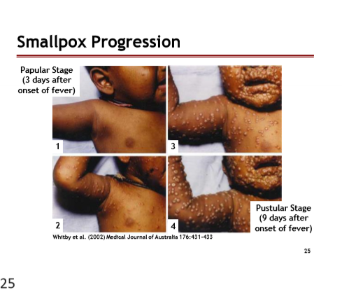 <p>Papular Stage: 3 days after onset of fever</p><p>Pustular Stage: 9 days after onset of fever</p><p></p>