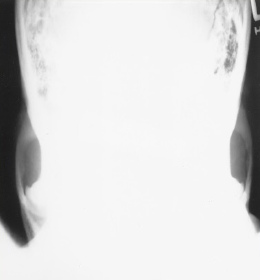 <p>What is this x-ray demonstrating?</p>