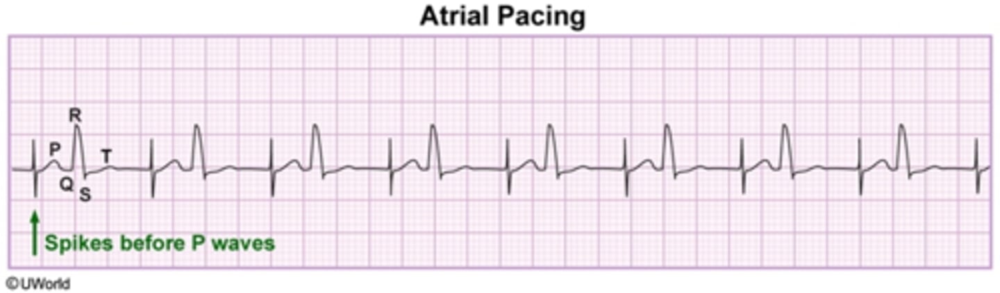 <p>spike before P wave</p>