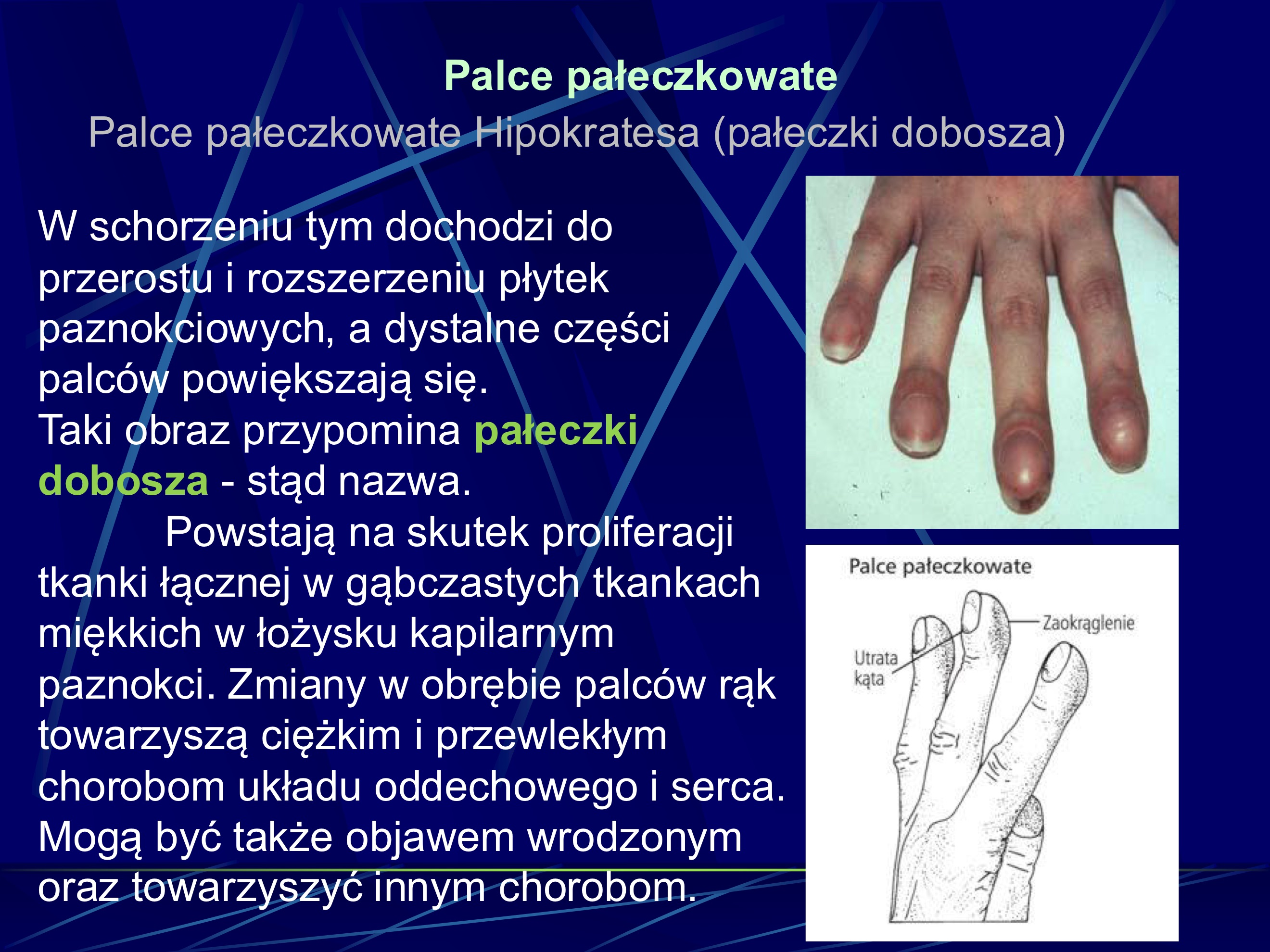 <p>Palce pateczkowate Hipokratesa (paleczki dobo-sza) sa objawem wystepujacym w przewleklych chorobach przebiegajacych z niedotlenieniem tkanek obwodowych. W schorzeniu tym dochodzi do przerostu i rozszerzenia plytek paznokcio-wych, a dystalne czesci palców powiekszaja sie.</p><p>uwaza sie, ze przewlekta hipoksja doprowadza do otwarcia glebokich poraczen tetniczo - zylnych w okolicy paliczków dystalnych i ich hipertrofie.</p>