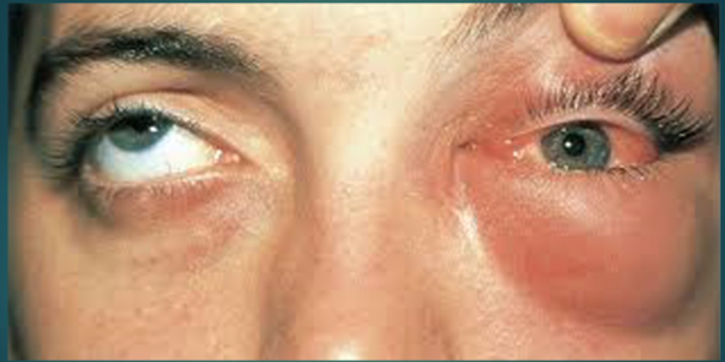 <p>Fever (unlike preseptal cellulitis), unilateral ocular pain, eyelid swelling, erythema, proptosis, chemosis, purulent discharge, sluggish pupillary response, ophthalmoplegia, impaired EOM, and pain with eye movement due to inflammation.</p>