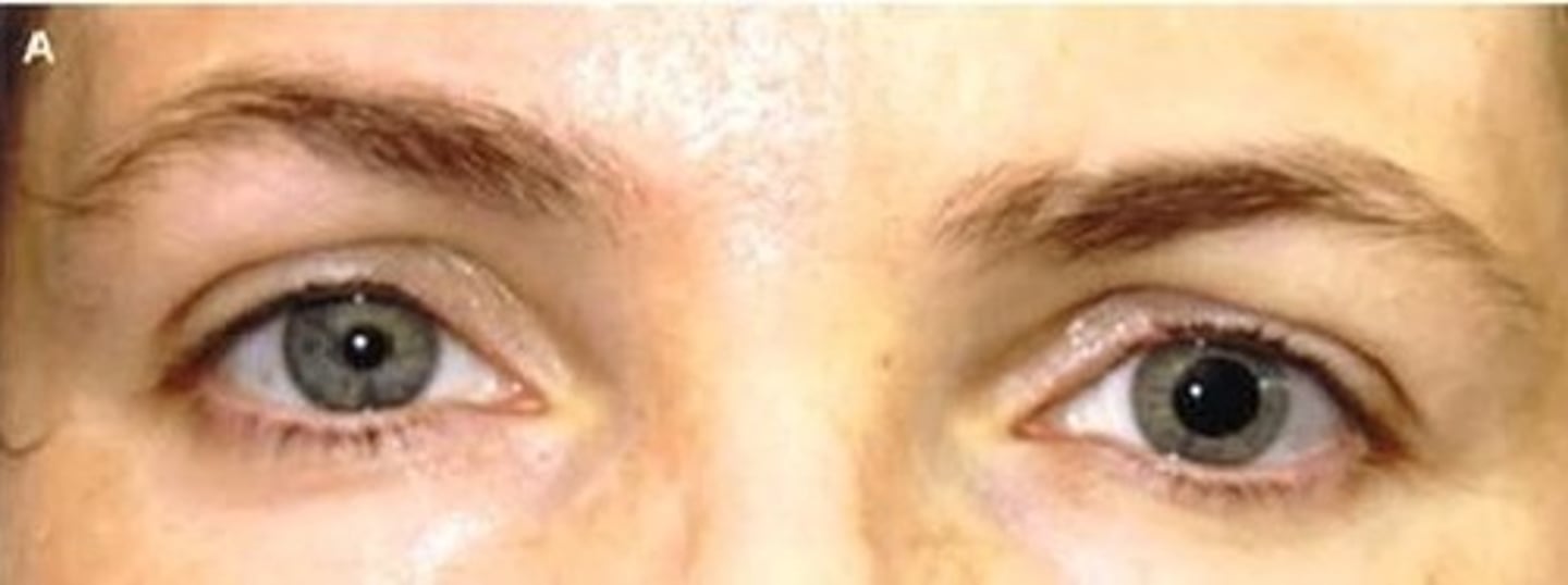 <p>an example of an anissocoria differential diagnosis where there is parasympathetic damage (unknown cause) resulting in unilateral dilated pupil</p>