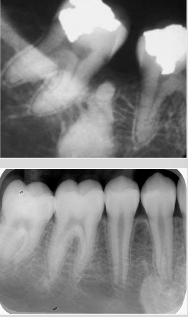 <p>No radiolucent rim, borders blend with surrounding trabeculae</p>