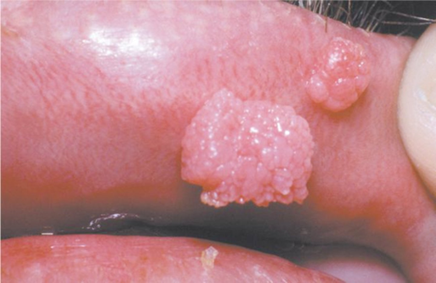 <p>Hint: clustered, sessile, pink, well-demarcated exophytic mass with blunted surface projections</p>